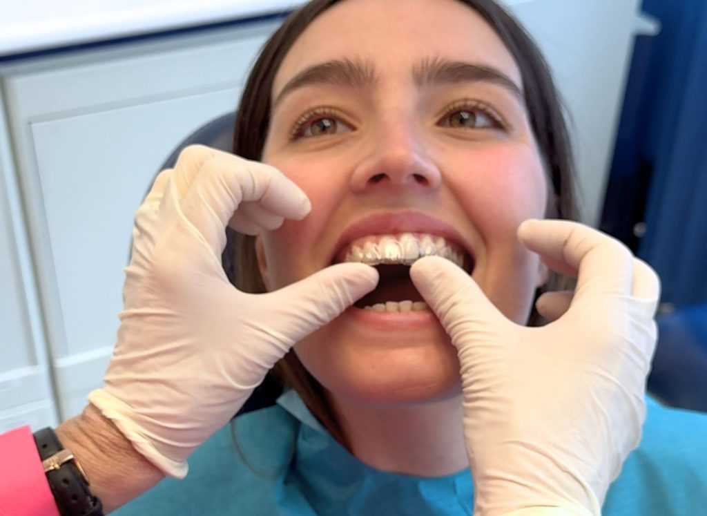 Apparecchio Trasparente: La Soluzione Moderna per il Tuo Sorriso 1 Apparecchio trasparente