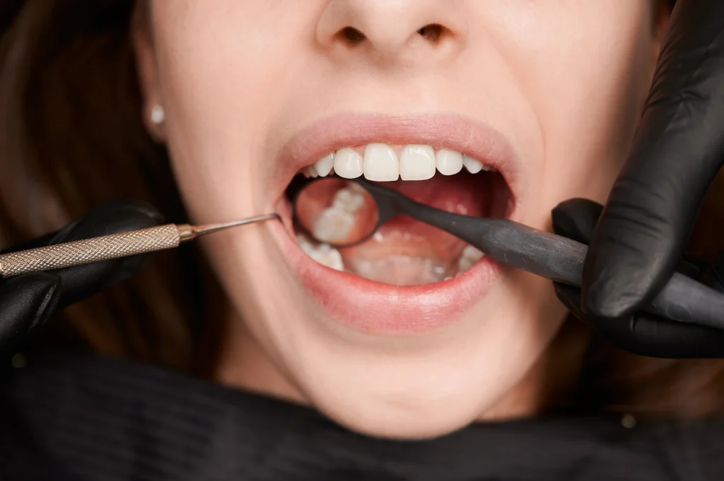 Posso fumare dopo aver tolto il dente del giudizio? 2 fumare dopo aver tolto il dente del giudizio